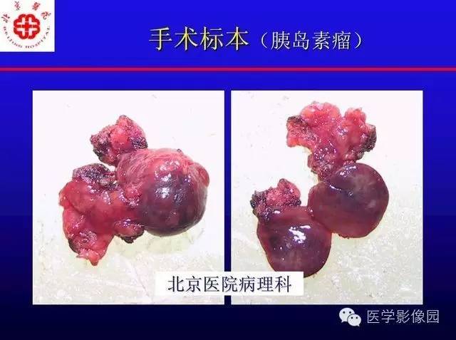 【PPT】MRI在腹部实质脏器病变诊断中的优势