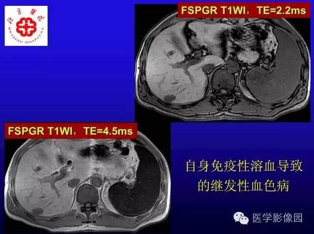 【PPT】MRI在腹部实质脏器病变诊断中的优势
