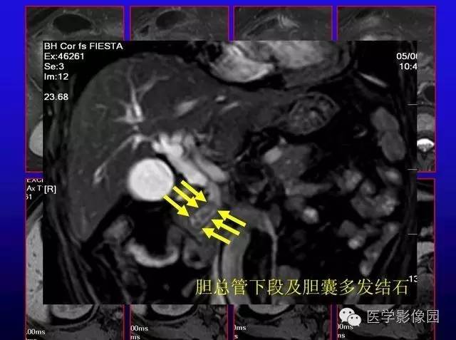 【PPT】MRI在腹部实质脏器病变诊断中的优势