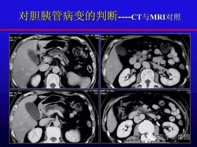 【PPT】MRI在腹部实质脏器病变诊断中的优势