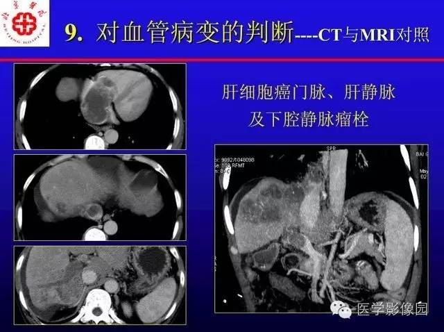 【PPT】MRI在腹部实质脏器病变诊断中的优势
