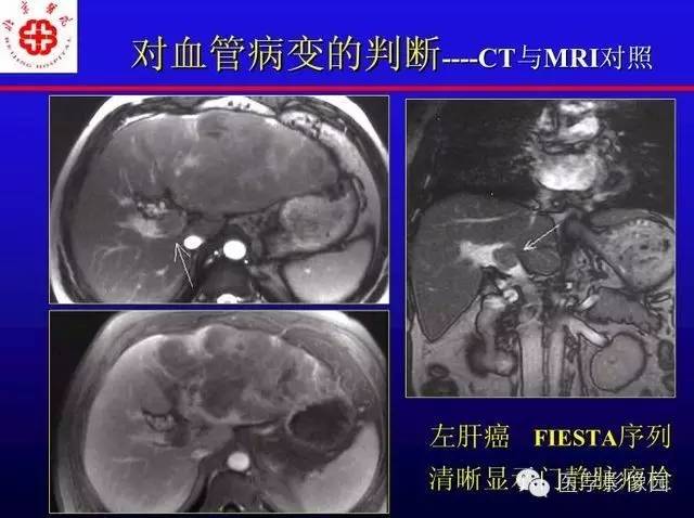 【PPT】MRI在腹部实质脏器病变诊断中的优势