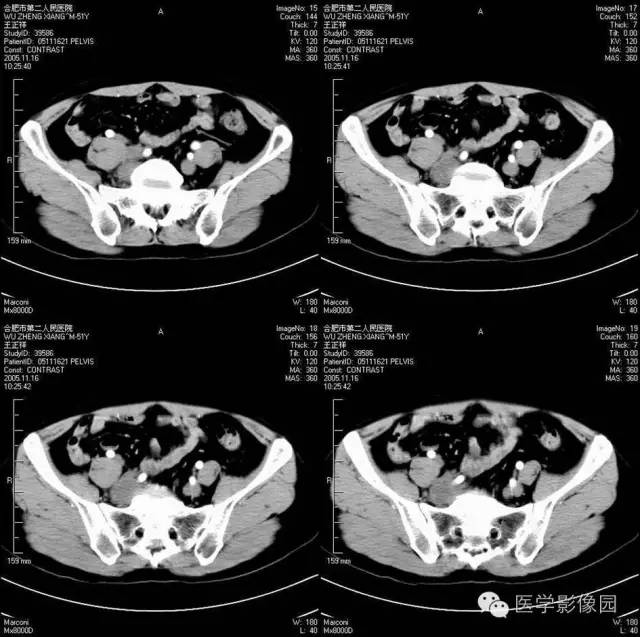【病例】腹膜后神经节细胞瘤1例CT影像表现 【病例】腹膜后神经节细胞瘤1例CT影像表现
