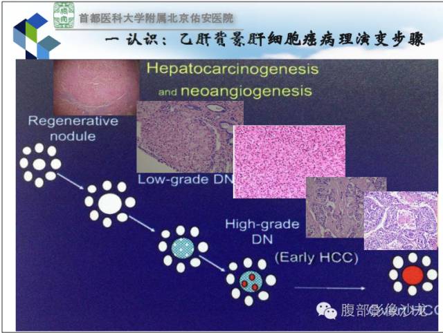 【PPT】HBV相关肝细胞癌演变MRI分级诊断