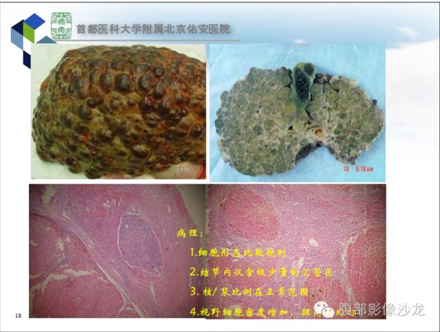 【PPT】HBV相关肝细胞癌演变MRI分级诊断