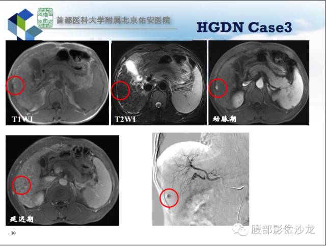 【PPT】HBV相关肝细胞癌演变MRI分级诊断