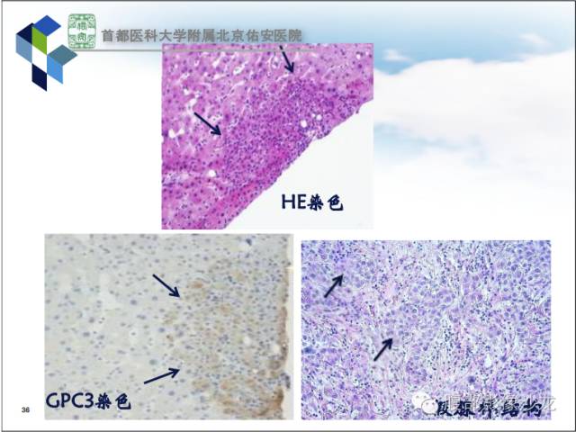 【PPT】HBV相关肝细胞癌演变MRI分级诊断