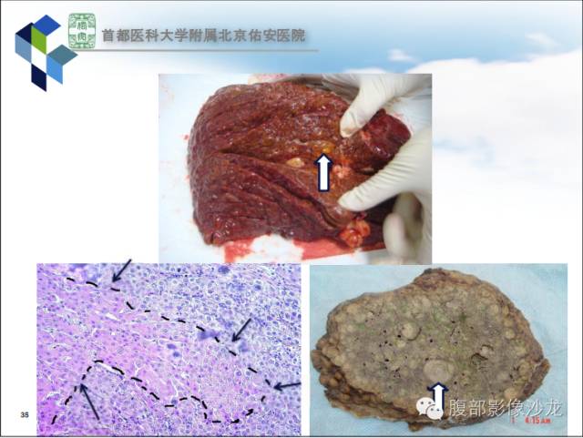 【PPT】HBV相关肝细胞癌演变MRI分级诊断