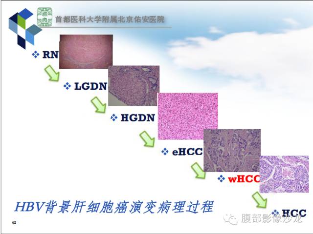 【PPT】HBV相关肝细胞癌演变MRI分级诊断