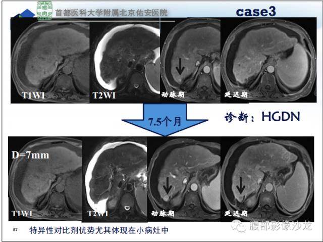 【PPT】HBV相关肝细胞癌演变MRI分级诊断