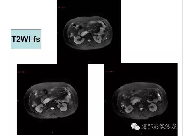 【病例】腹膜后血管瘤1例CT及MR影像表现