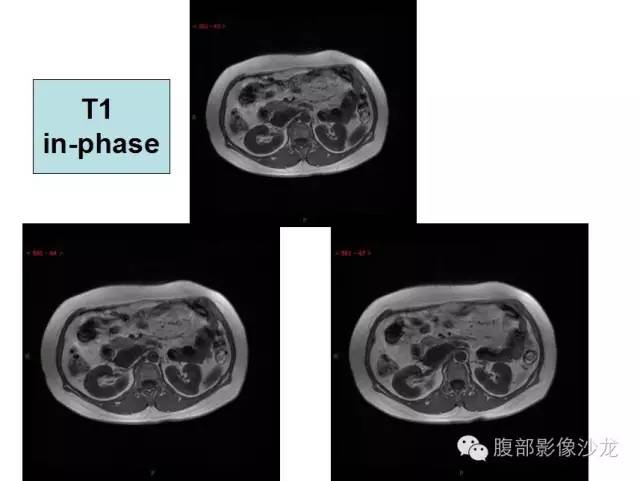 【病例】腹膜后血管瘤1例CT及MR影像表现