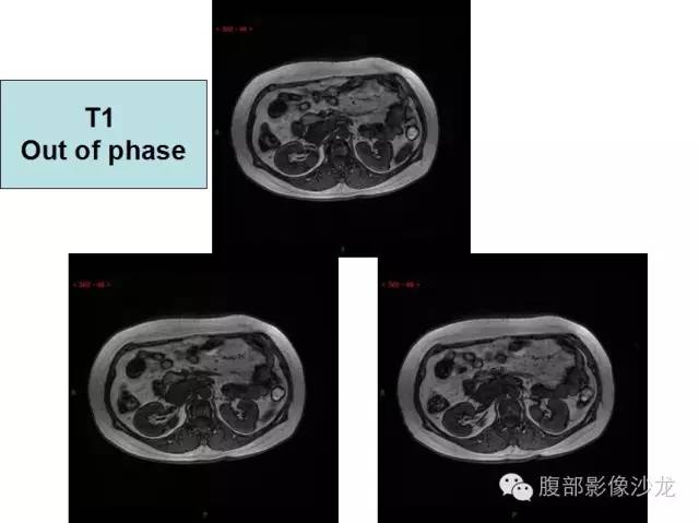 【病例】腹膜后血管瘤1例CT及MR影像表现