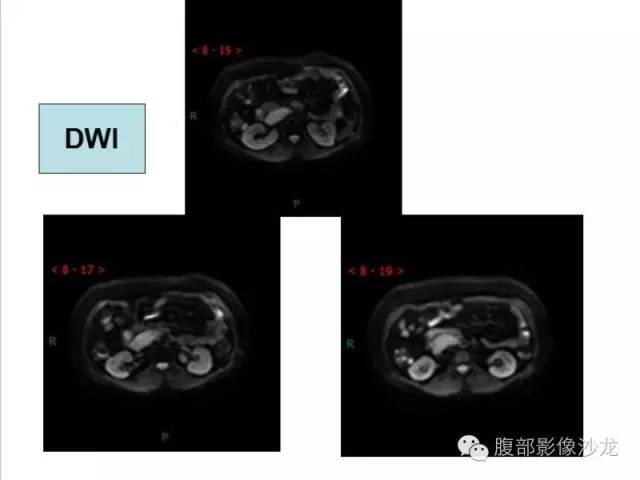 【病例】腹膜后血管瘤1例CT及MR影像表现