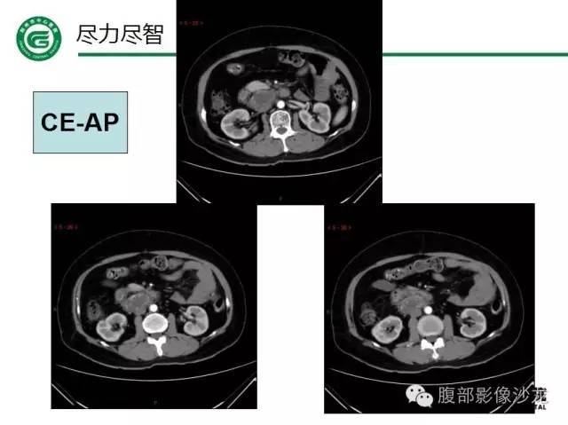 【病例】腹膜后血管瘤1例CT及MR影像表现