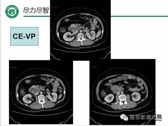 【病例】腹膜后血管瘤1例CT及MR影像表现