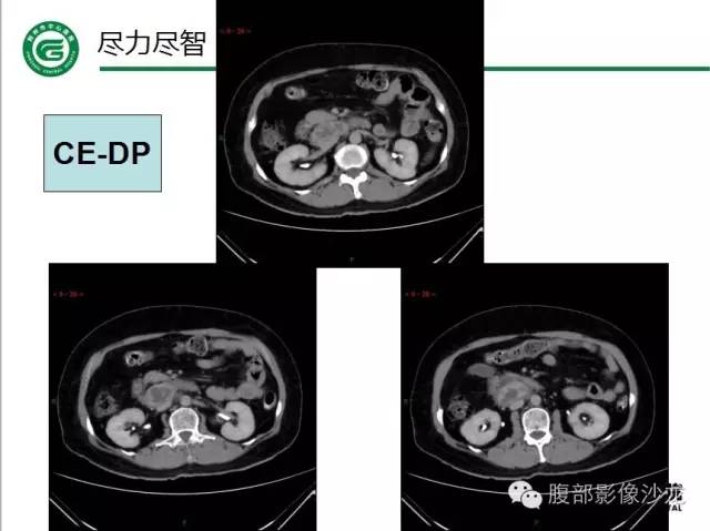 【病例】腹膜后血管瘤1例CT及MR影像表现
