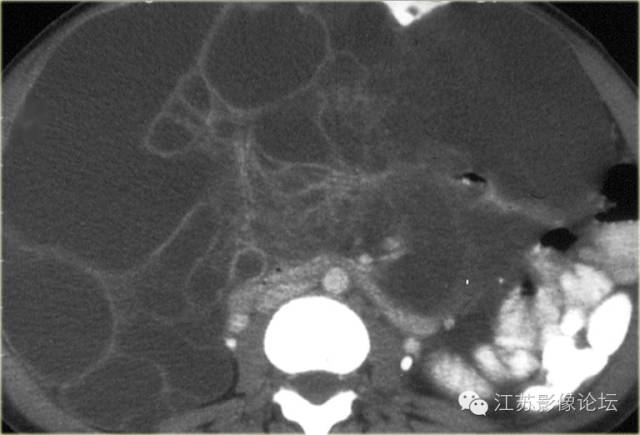 腹膜及肠系膜病变影像学分析 腹膜及肠系膜病变影像学分析