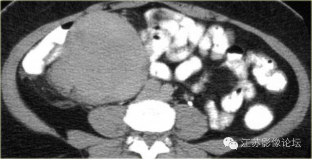 腹膜及肠系膜病变影像学分析 腹膜及肠系膜病变影像学分析