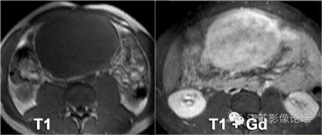 腹膜及肠系膜病变影像学分析 腹膜及肠系膜病变影像学分析