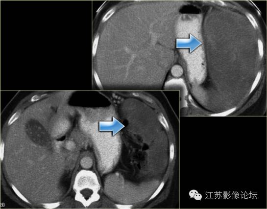 腹膜及肠系膜病变影像学分析 腹膜及肠系膜病变影像学分析