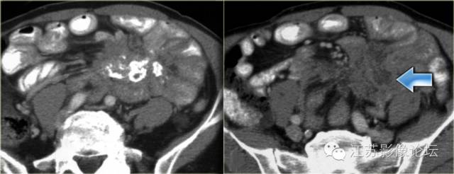 腹膜及肠系膜病变影像学分析 腹膜及肠系膜病变影像学分析