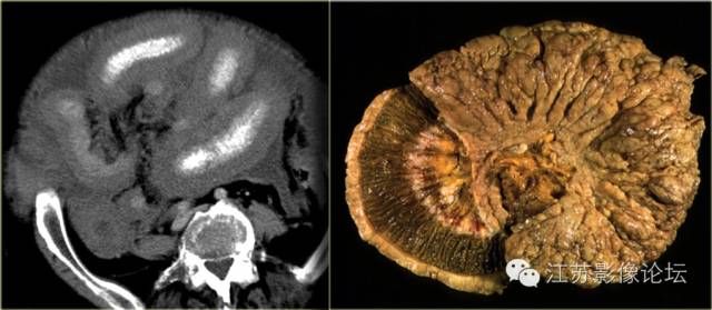 腹膜及肠系膜病变影像学分析 腹膜及肠系膜病变影像学分析