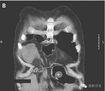 【病例】Morgagni疝致肺塌陷1例CT影像表现 【病例】Morgagni疝致肺塌陷1例CT影像表现