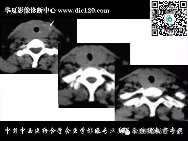 【PPT】颈部常见病变影像诊断