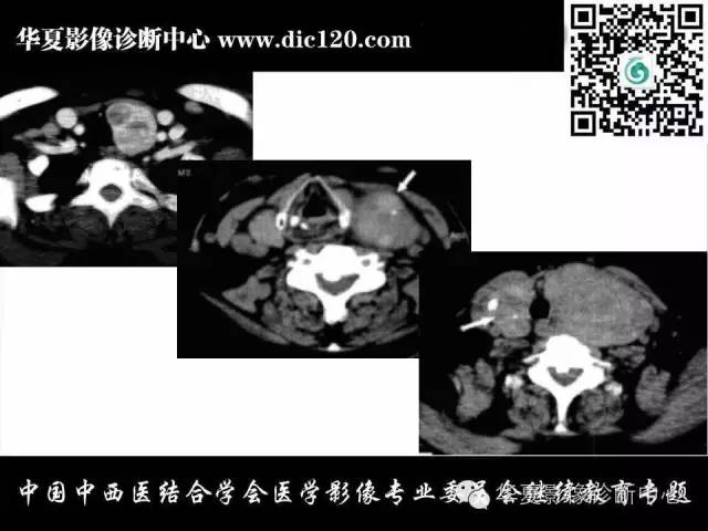 【PPT】颈部常见病变影像诊断
