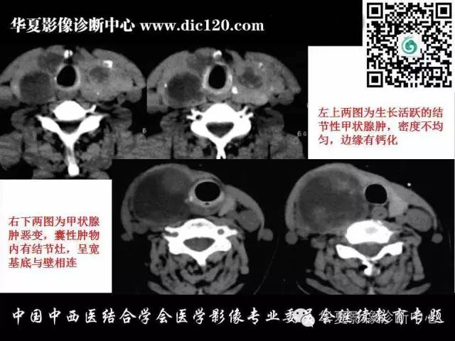 【PPT】颈部常见病变影像诊断