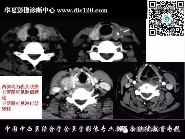 【PPT】颈部常见病变影像诊断