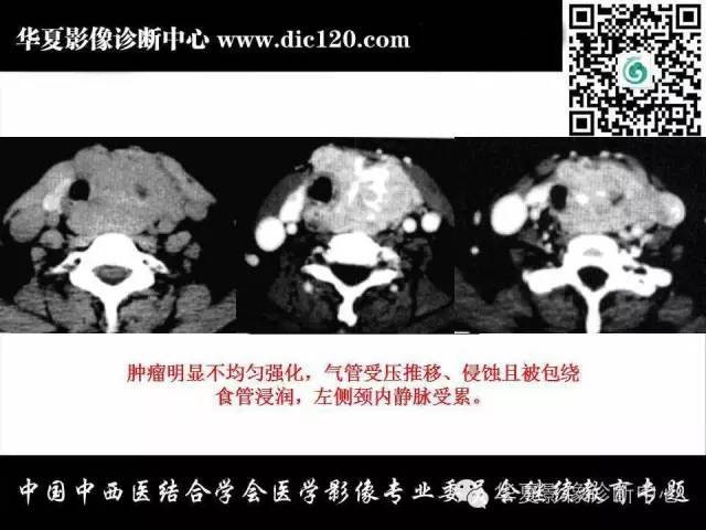 【PPT】颈部常见病变影像诊断