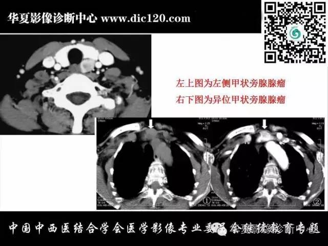 【PPT】颈部常见病变影像诊断