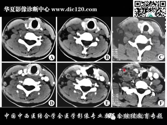 【PPT】颈部常见病变影像诊断
