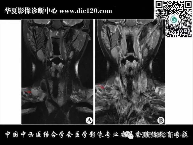 【PPT】颈部常见病变影像诊断