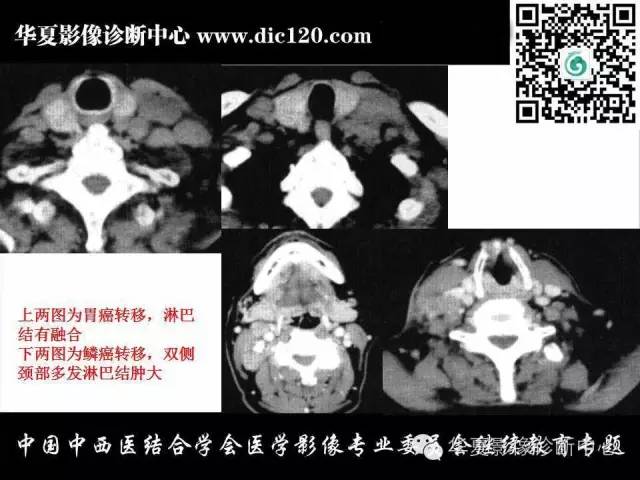 【PPT】颈部常见病变影像诊断