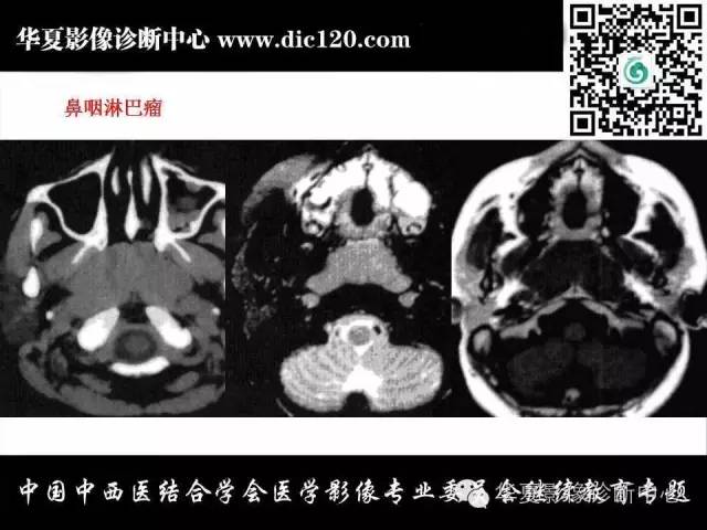 【PPT】颈部常见病变影像诊断
