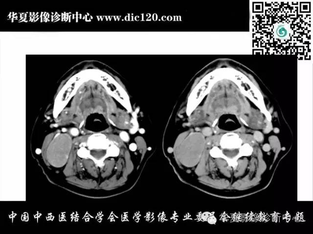 【PPT】颈部常见病变影像诊断
