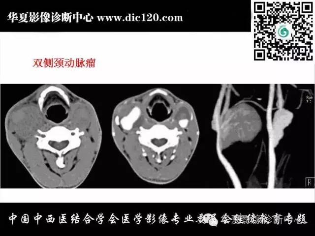 【PPT】颈部常见病变影像诊断