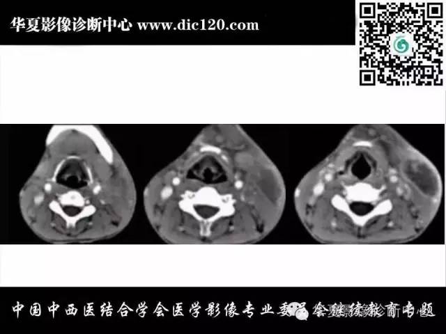 【PPT】颈部常见病变影像诊断
