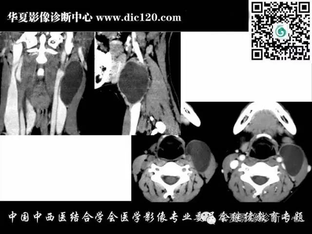 【PPT】颈部常见病变影像诊断