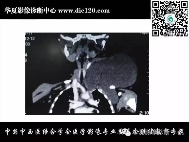 【PPT】颈部常见病变影像诊断