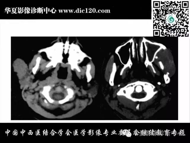 【PPT】颈部常见病变影像诊断