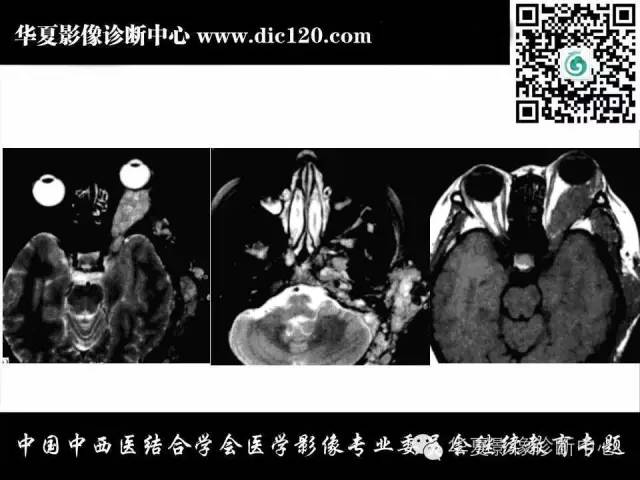 【PPT】颈部常见病变影像诊断