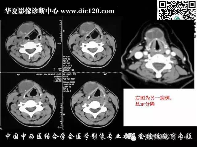 【PPT】颈部常见病变影像诊断
