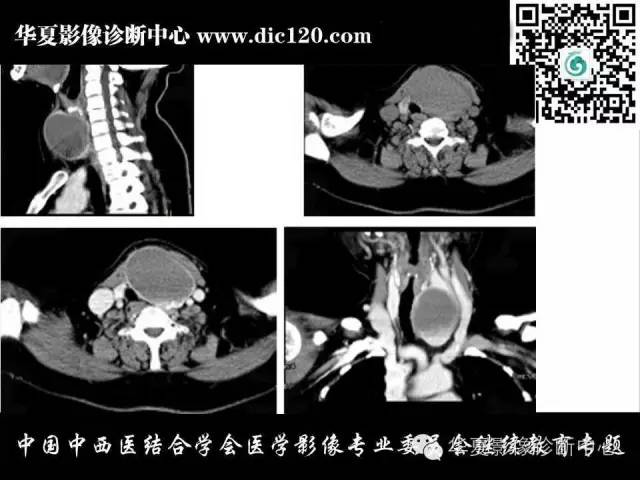 【PPT】颈部常见病变影像诊断