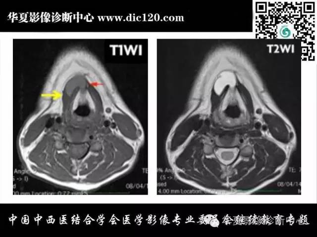 【PPT】颈部常见病变影像诊断