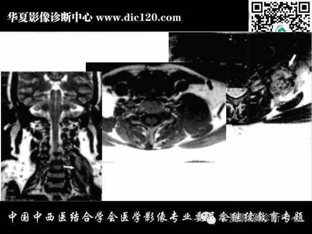 【PPT】颈部常见病变影像诊断