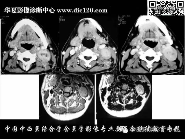 【PPT】颈部常见病变影像诊断